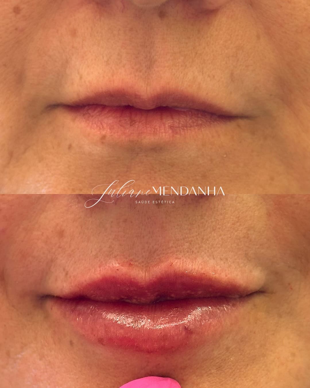 Antes e depois de preenchimento labial: em cima o lábio antes, embaixo o mesmo lábio depois, mais definido e ainda delicado