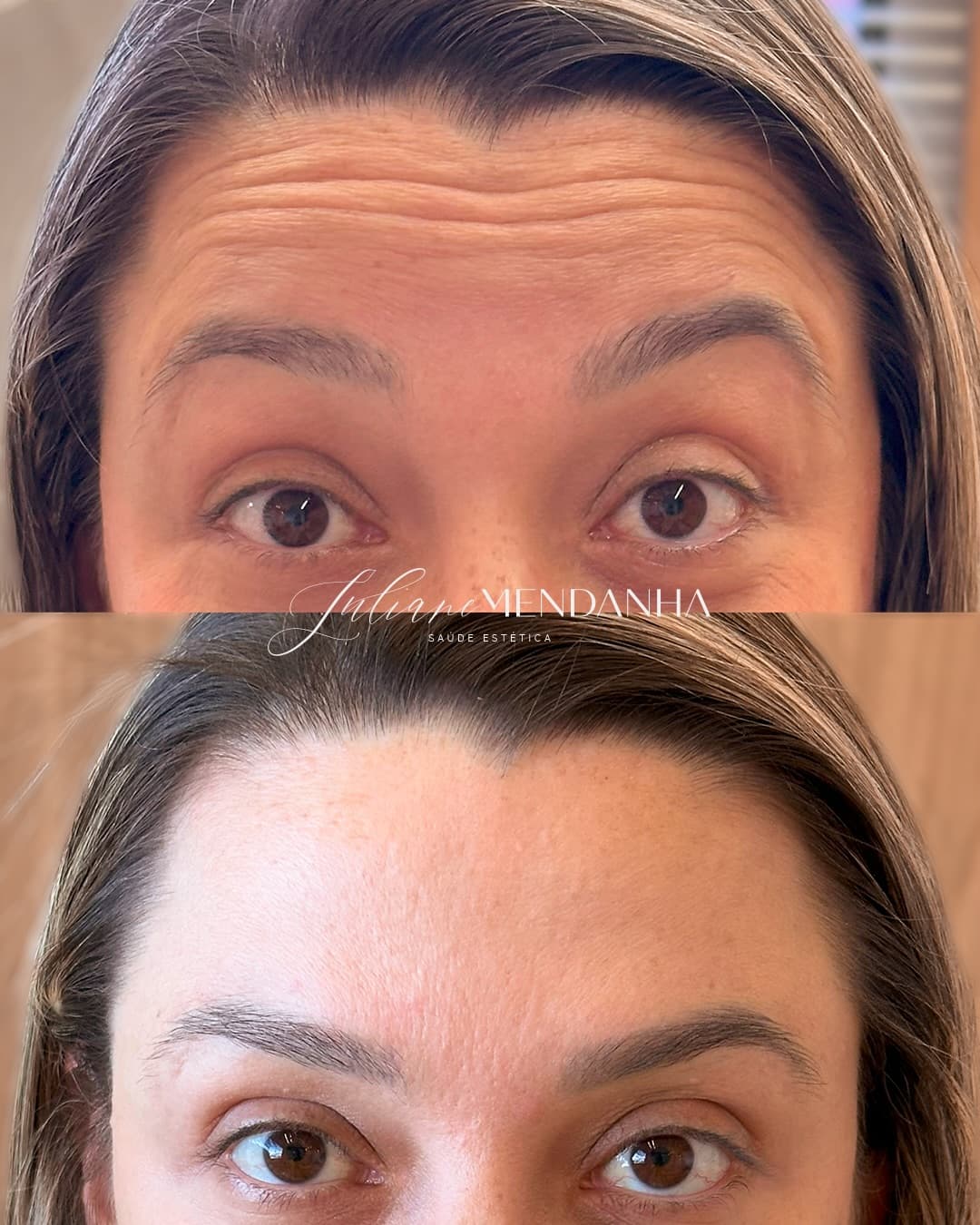 Antes e depois de toxina botulínica na testa: em cima as linhas marcadas, embaixo a testa lisa e a expressão mais leve