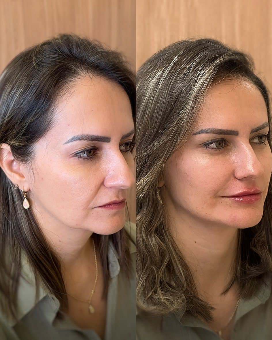 Antes e depois do protocolo RevLift: a mesma paciente de três quartos, com a mesma luz, à esquerda antes e à direita depois